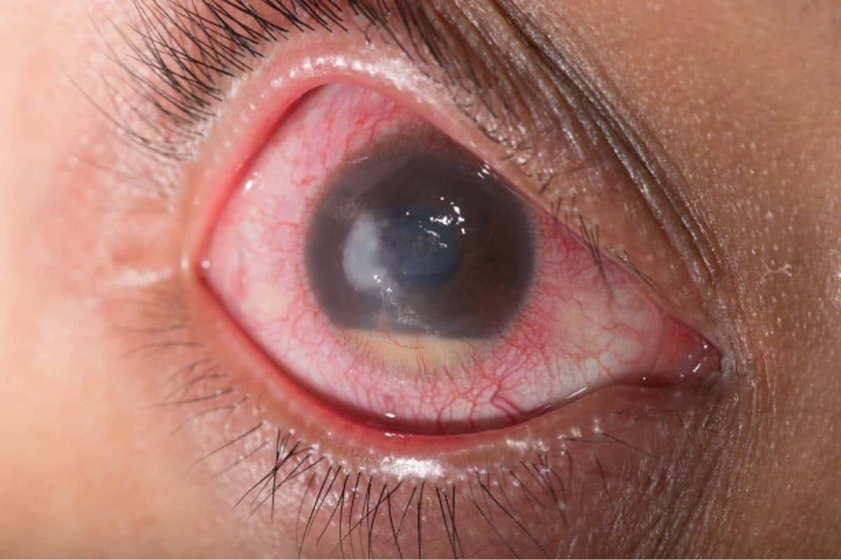 Ojo, precauciones para evitar el Glaucoma