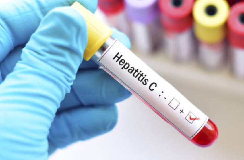 "El 78% de los casos de cáncer hepático primario es por hepatitis B o C"