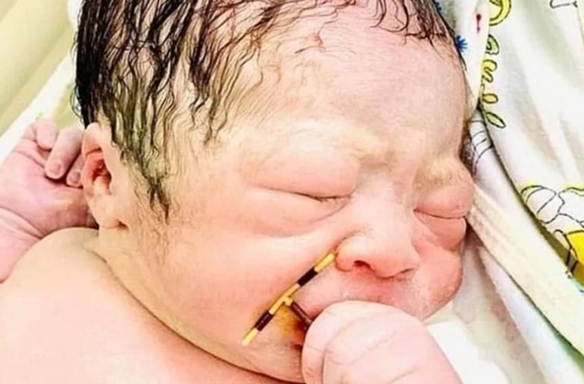 Un bebé nació con el DIU de su madre en la mano y se volvió viral