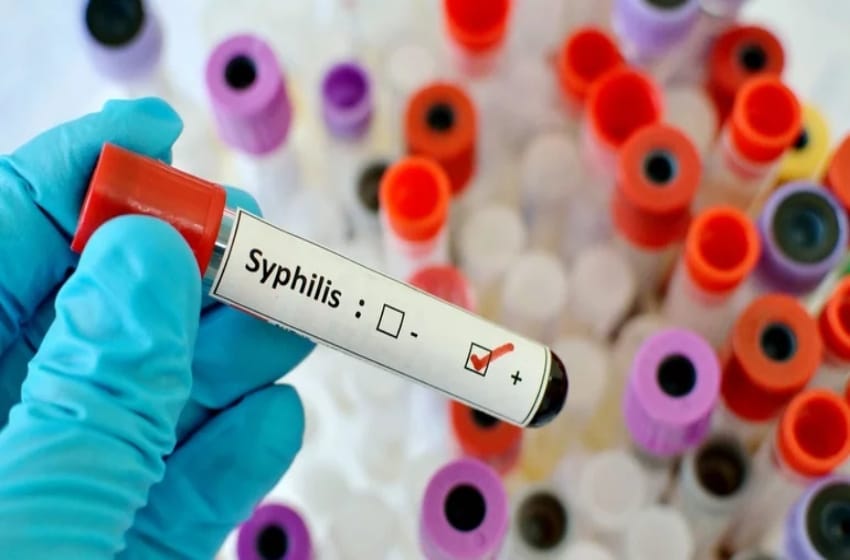 Sífilis: una infección frecuente por transmisión sexual
