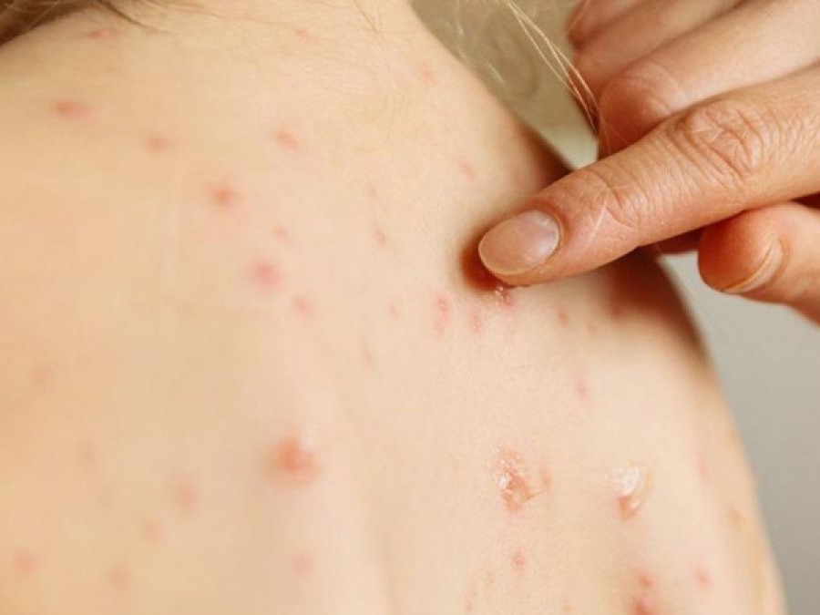 Measles Update: Virus Not Circulating in Mar del Plata – Expert Confirmation